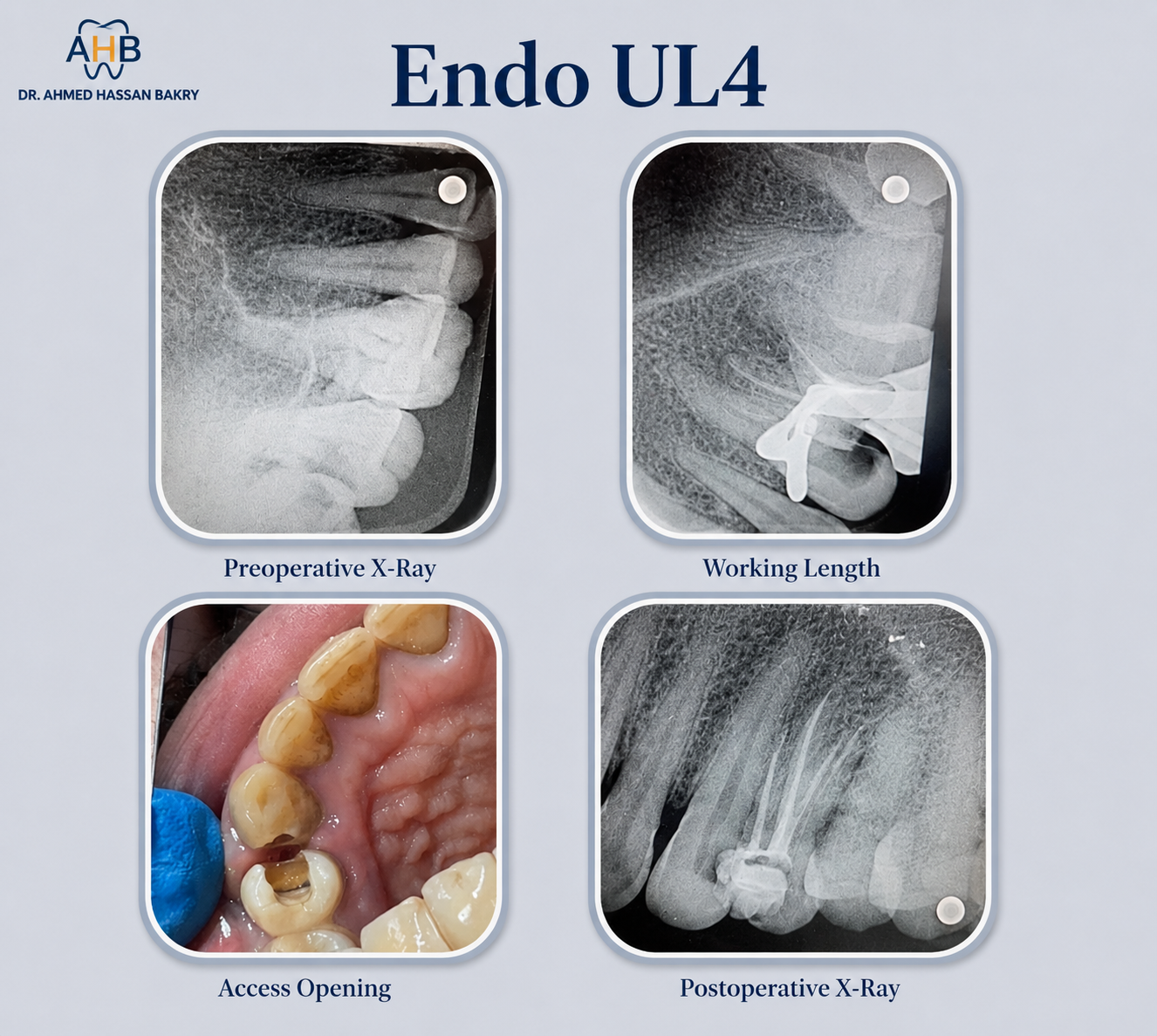 Endo UL4